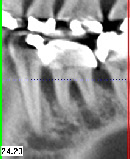 Knochenabbau zwischen Zähnen