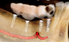 Detailansicht Implantate nervus mandibularis